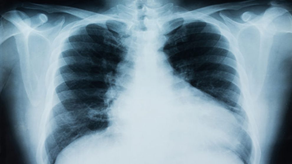 Simptomi raka pluća